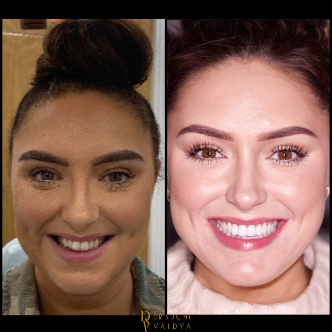 Before and after smile makeover at Brampton Dental Practice