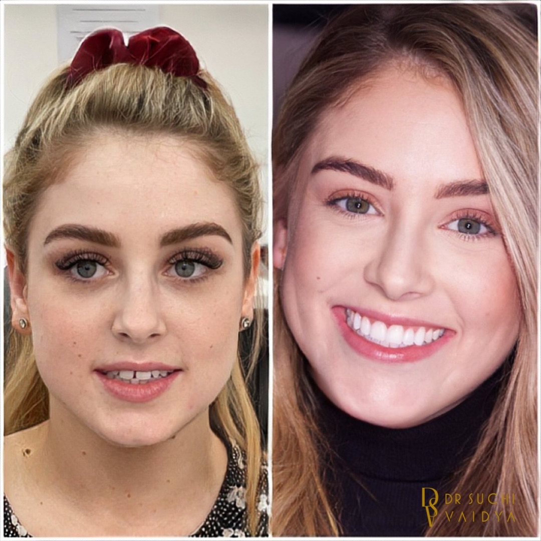 Before and after bonding & whitening at Brampton Dental Practice