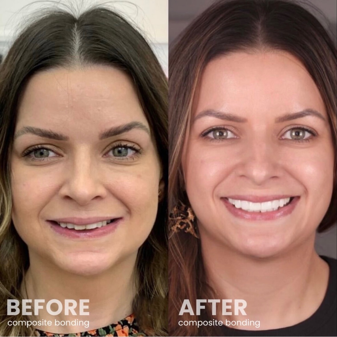 Before and after composite bonding at Brampton Dental Practice