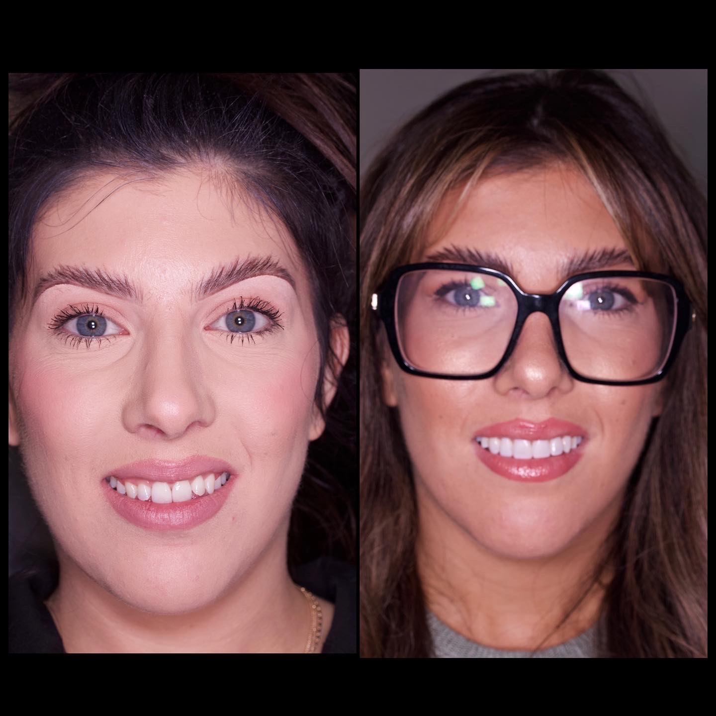 Before and after porcelain veneers at Brampton Dental Practice